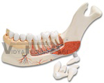 Advanced Half Lower Jaw with 8 diseased teeth, 19 part